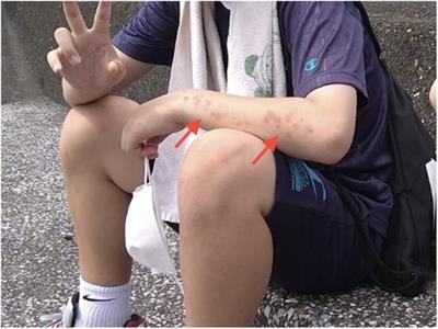 Case report: Diagnostic clues for anti-3-hydroxy-3-methylglutaryl-coenzyme A reductase myopathy in pediatric patients